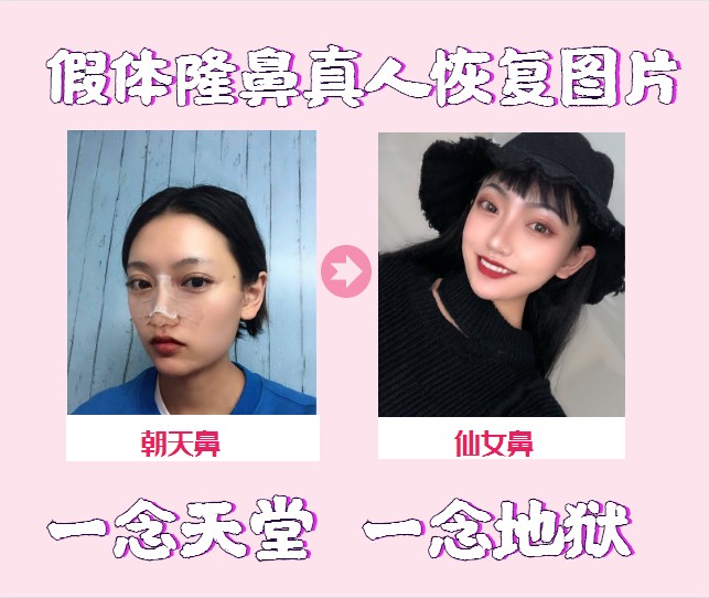 假体隆鼻真人恢复过程记录